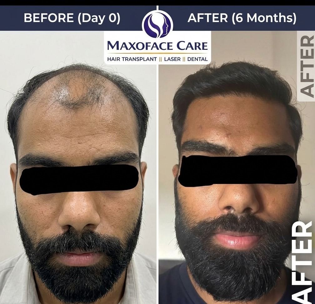 Hair Transplant — Day 0 vs 6 Months